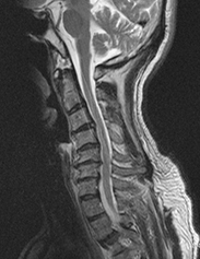 頸椎MRI矢状断（側面）