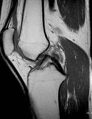 膝関節MRI矢状断（側面）
