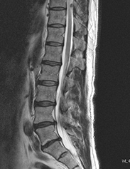 腰椎MRI矢状断（側面）