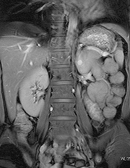 腹部MRI冠状断（正面）